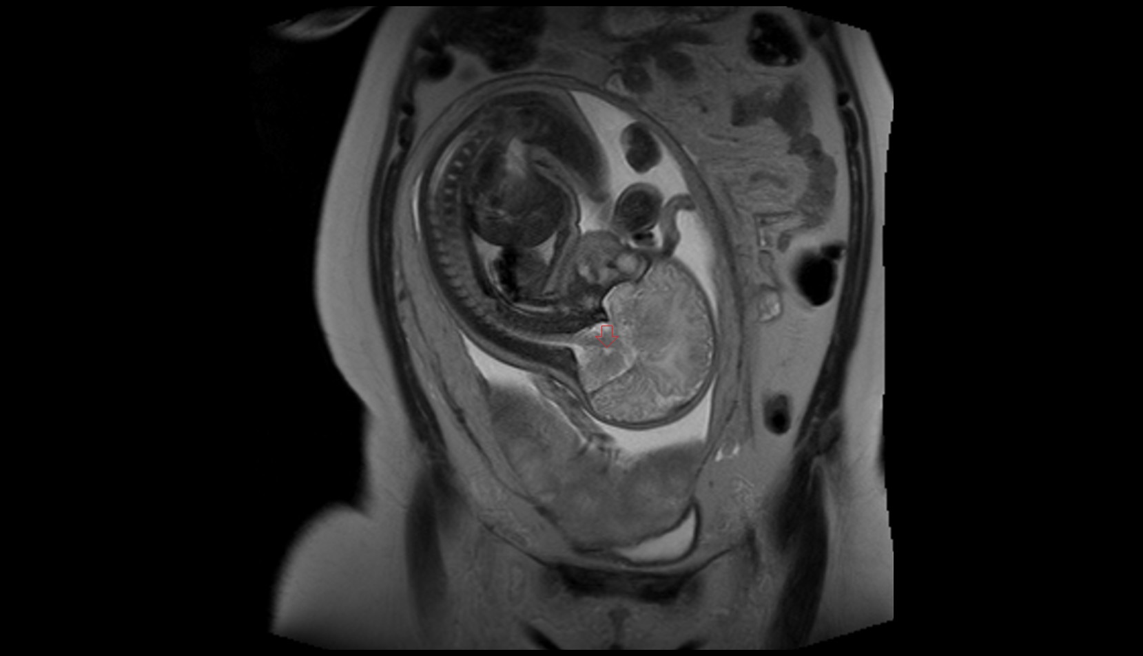 Fetal fourth ventricle MRI image