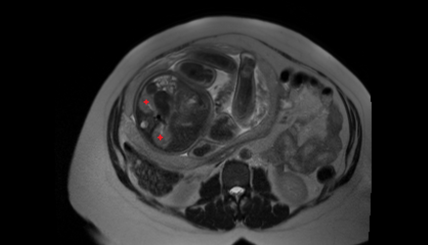Fetal kidneys  MRI axial  anatomy image-img-00000-00000