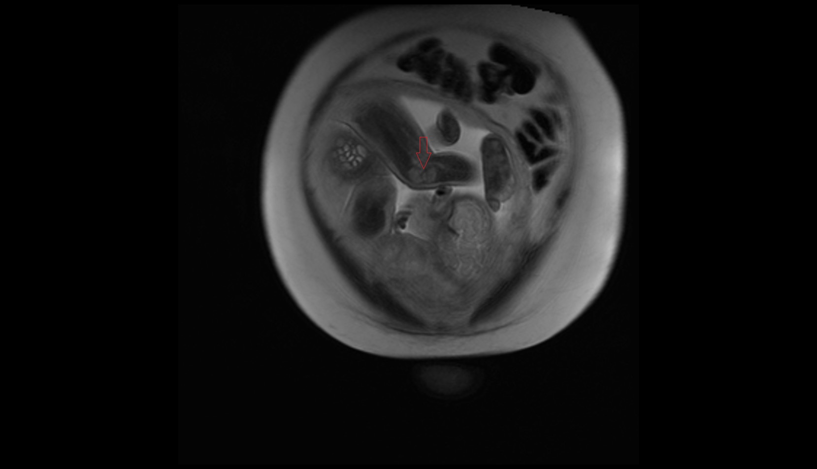 Fetal knee mri coronal image