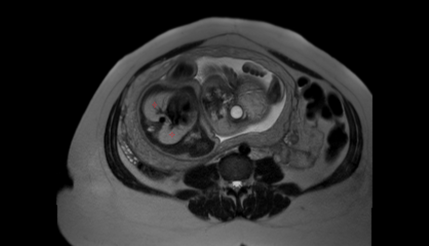 Fetal lungs  MRI axial  anatomy image-img-00000-00000