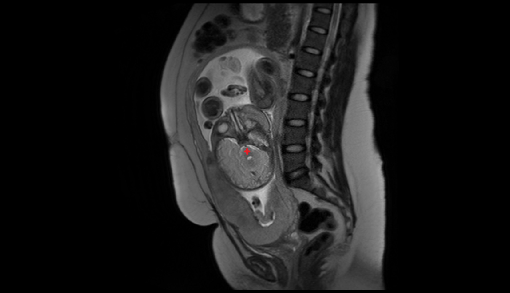 Fetal pons MRI image