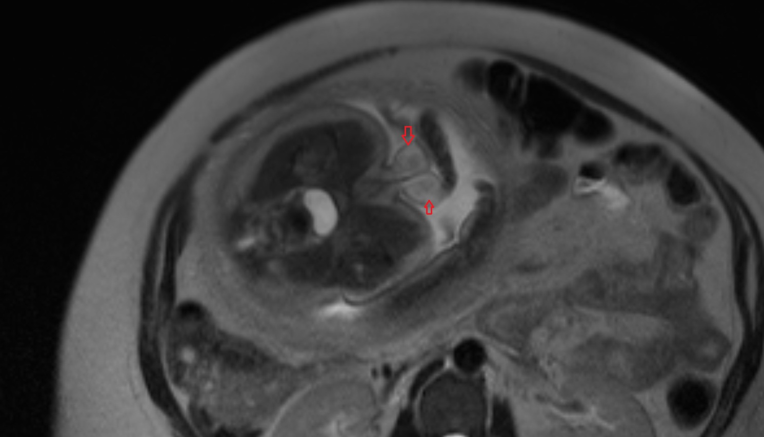 Fetal scrotum   MRI axial  anatomy image-img-00000-00000