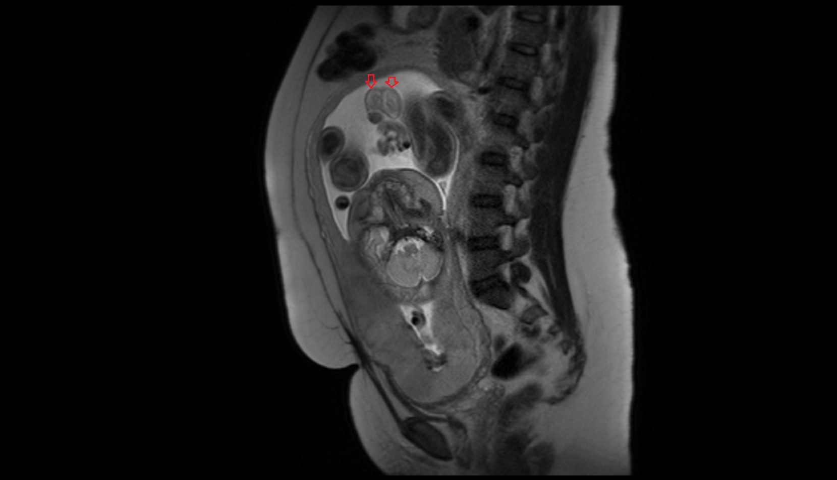 Fetal scrotum  mri coronal
