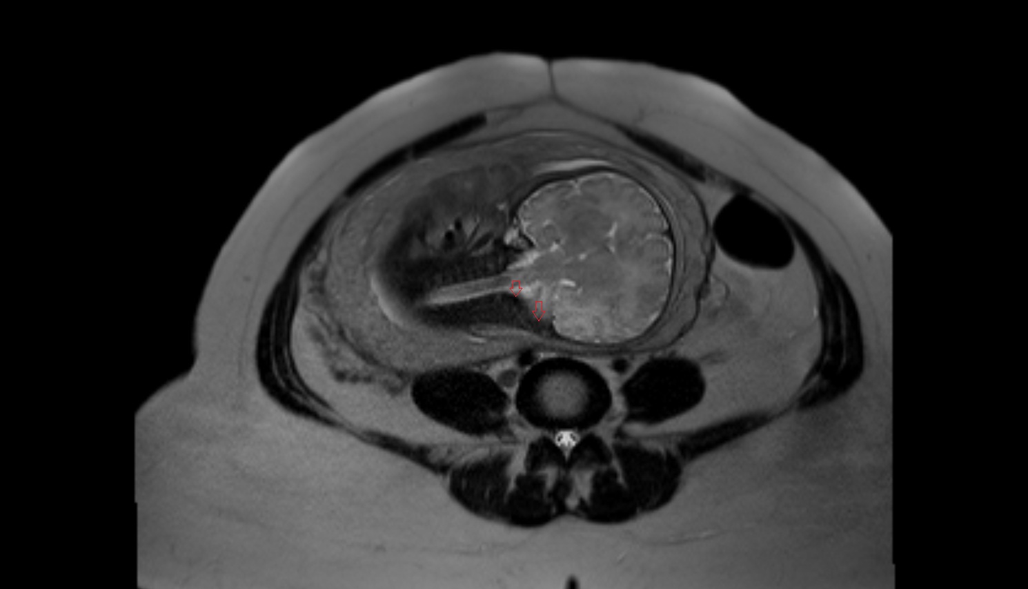 Fetal sigmoid sinus   MRI coronal  anatomy image-img-00000-00000