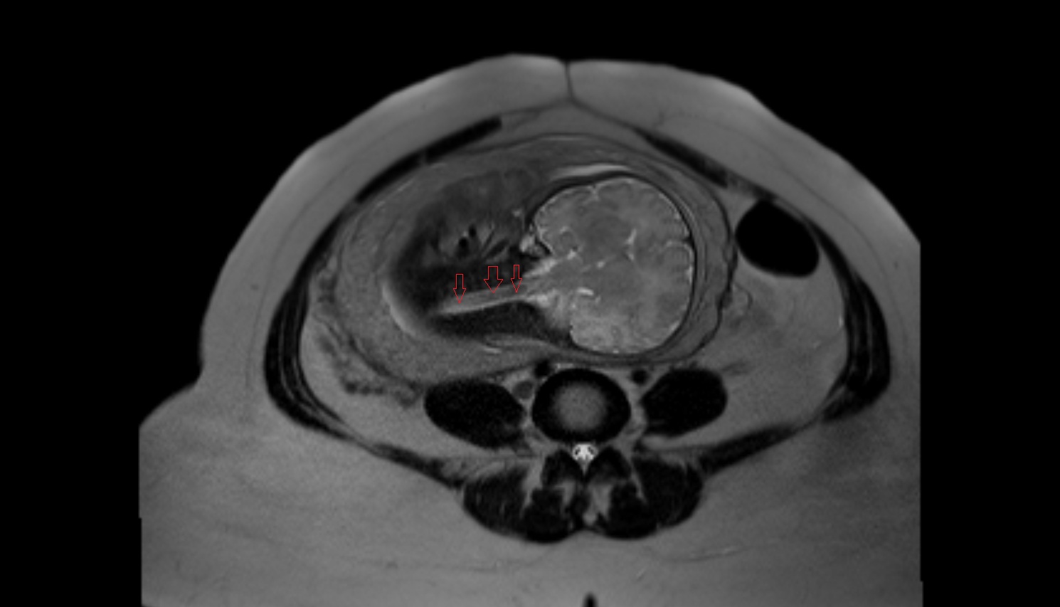 Fetal spinal cord  MRI coronal  anatomy image-img-00000-00000_00001