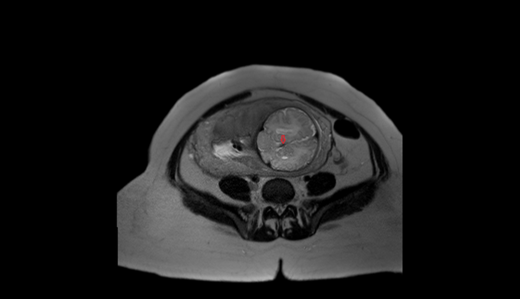 Fetal straight sinus MRI image
