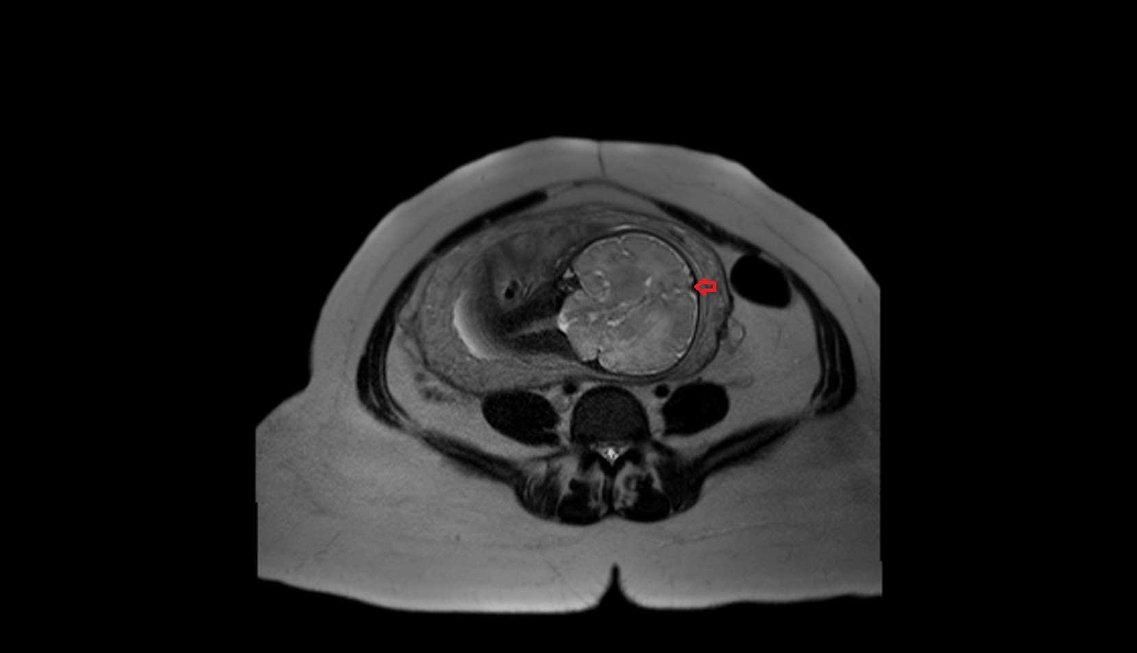 Fetal superior sagittal sinus mri image
