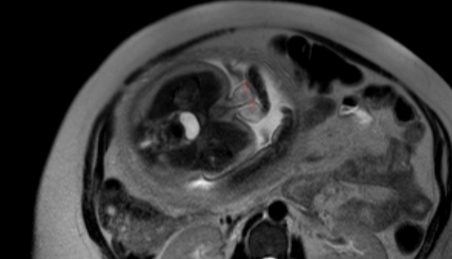 Fetal testis  MRI axial  anatomy image-img-00000-00000