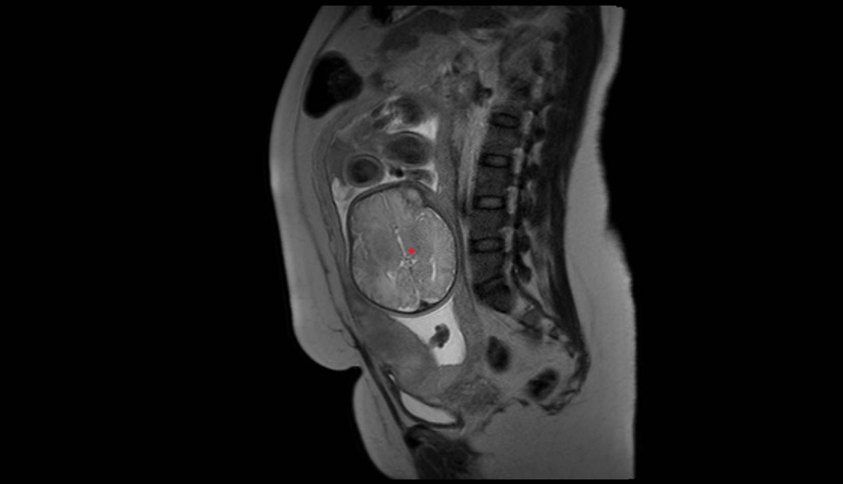 Fetal thalamus MRI image