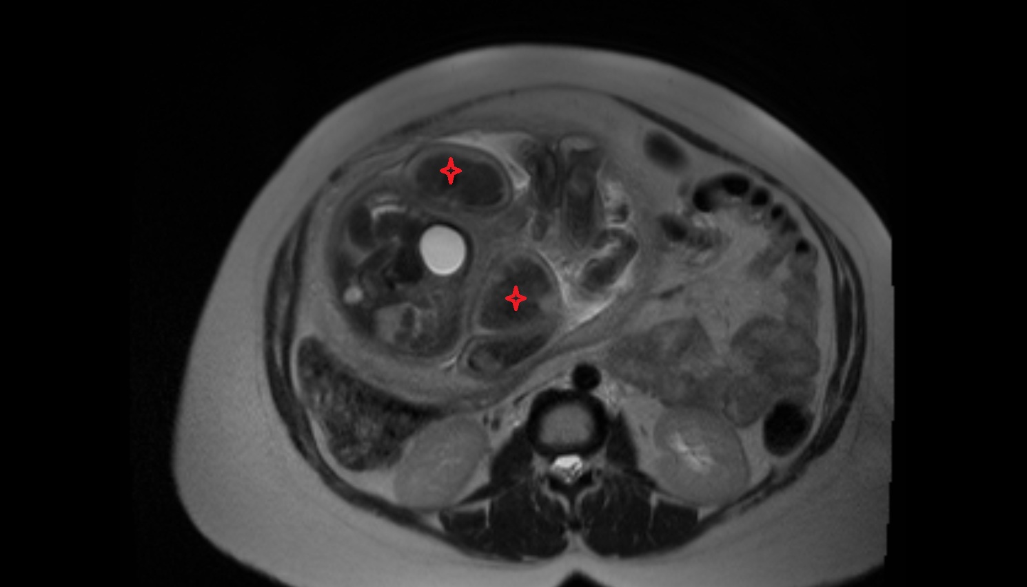 Fetal thigh  MRI axial  anatomy image-img-00000-00000