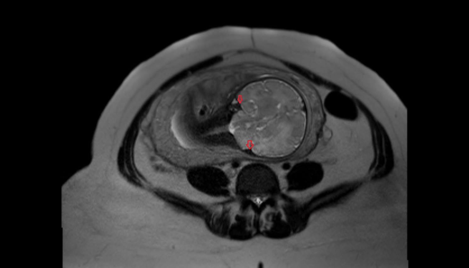 Fetal transverse sinus   MRI coronal  anatomy image-img-00000-00000
