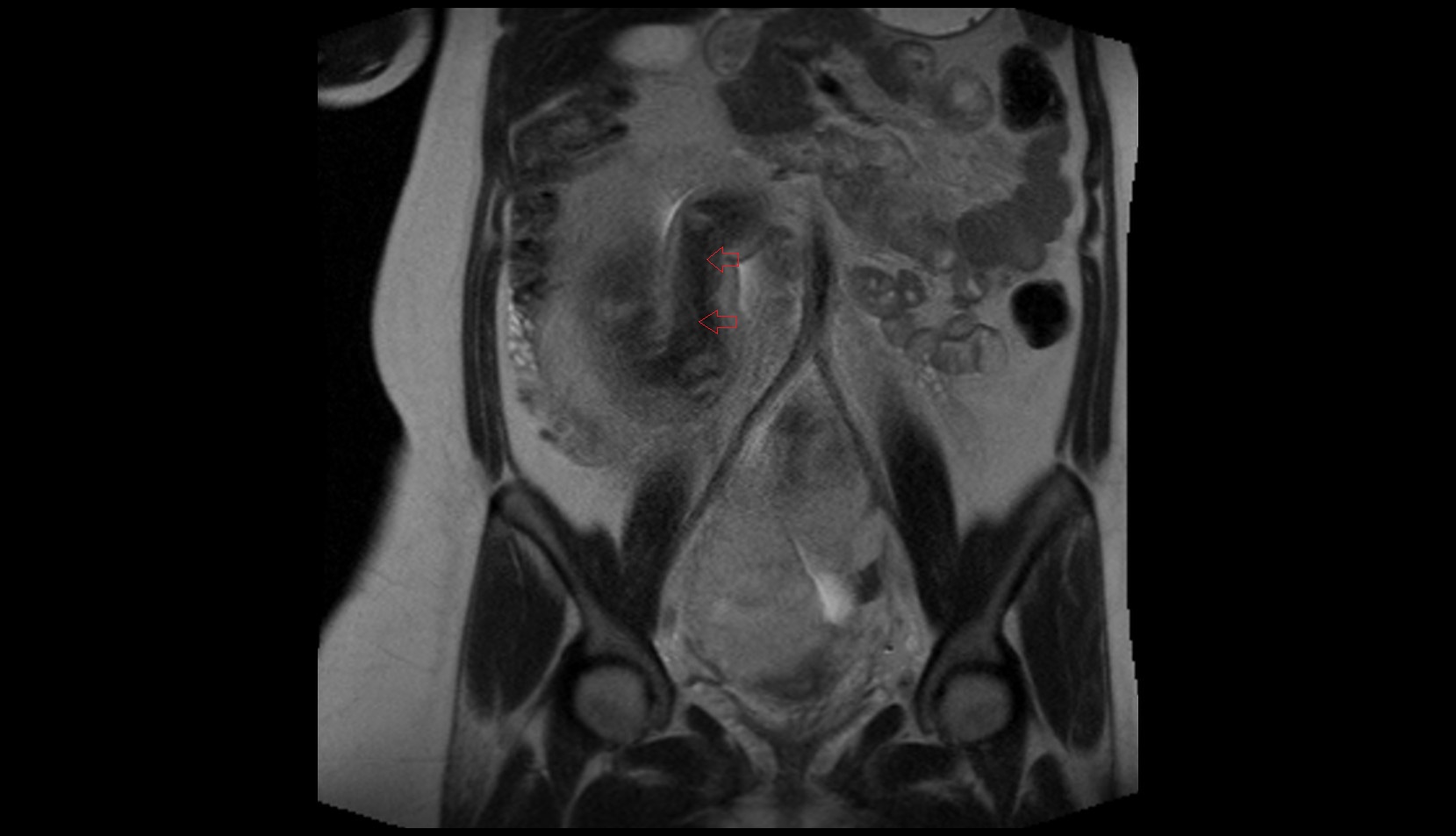 Fetal upper arm mri coronal image