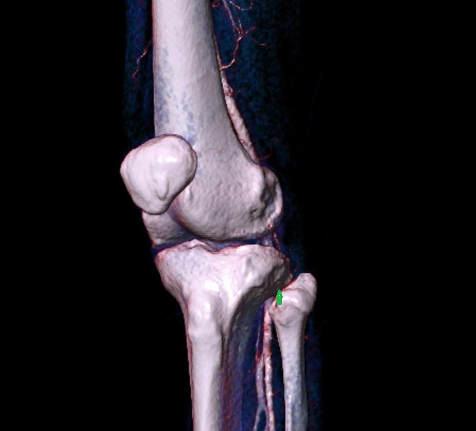 Fibular articular facet of tibia 3d