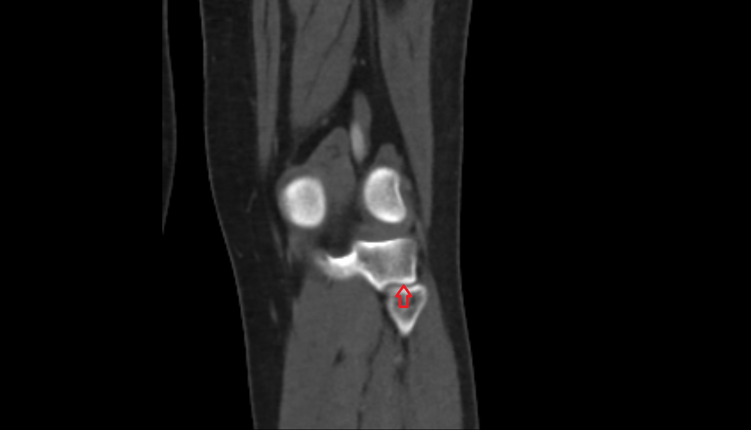 Fibular articular facet of tibia ct  anatomy labelled image-img-00000-00000