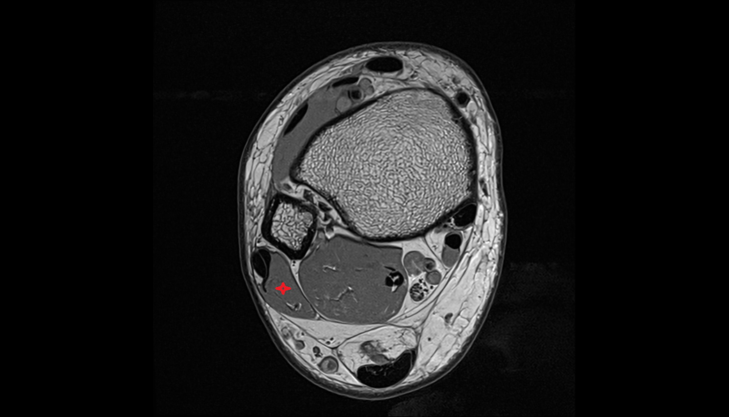 Fibularis brevis muscle   MRI axial  cross sectional anatomy 3T MRI AI enhanced radiology image-img-00000-00000