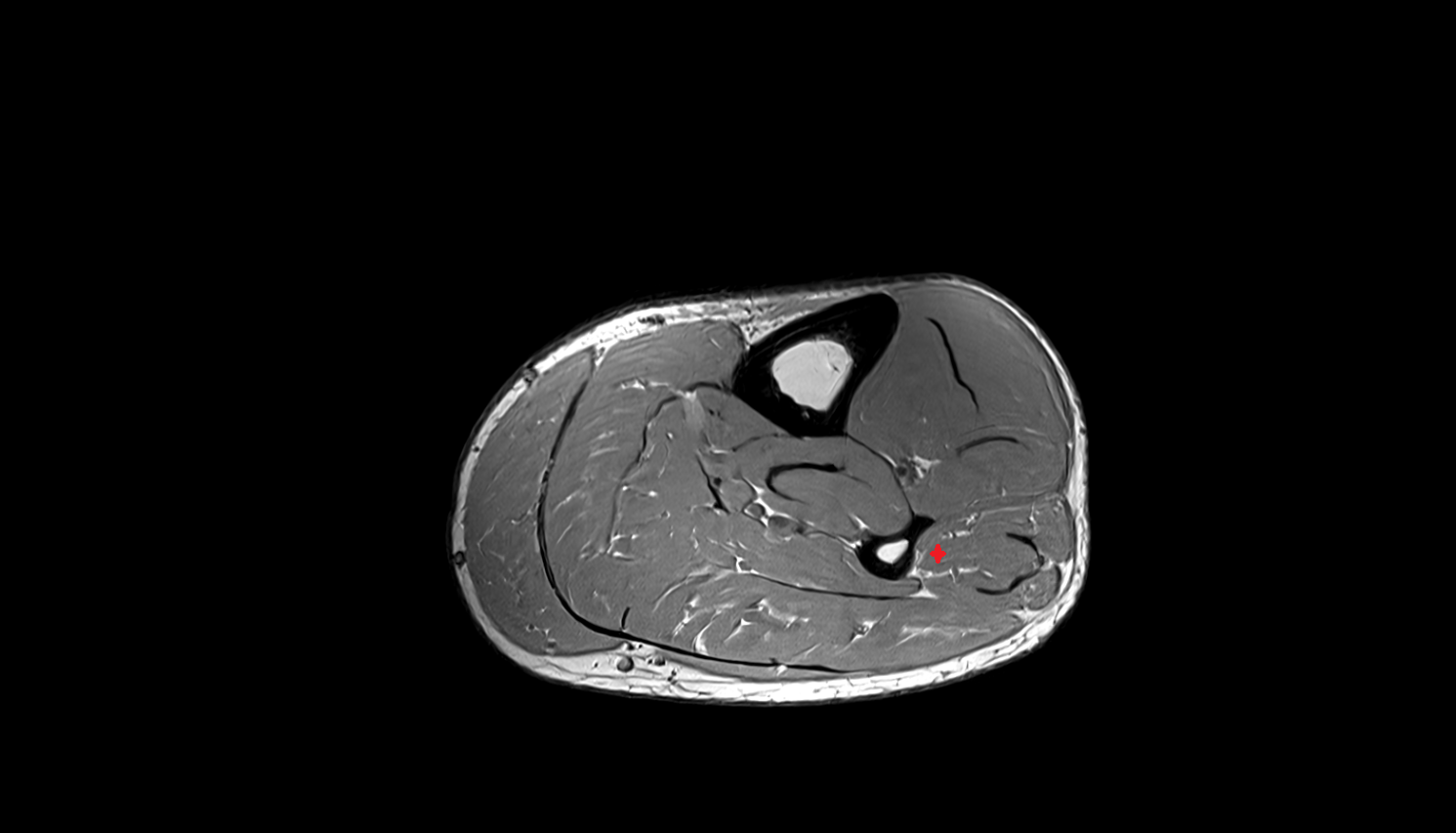 Fibularis brevis muscle   MRI sag  cross sectional anatomy 3T MRI AI enhanced radiology image-img-00000-00000