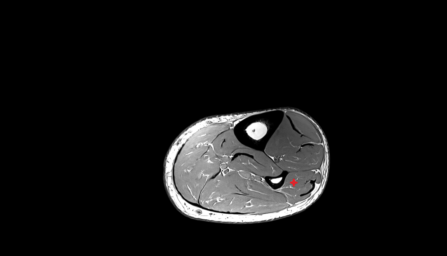 Fibularis brevis muscle   MRI sag  cross sectional anatomy 3T MRI AI enhanced radiology image-img-00000-00000_00001