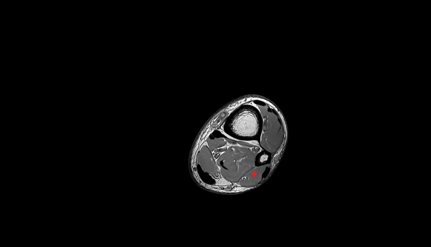 Fibularis brevis muscle   MRI sag  cross sectional anatomy 3T MRI AI enhanced radiology image-img-00000-00000_00002