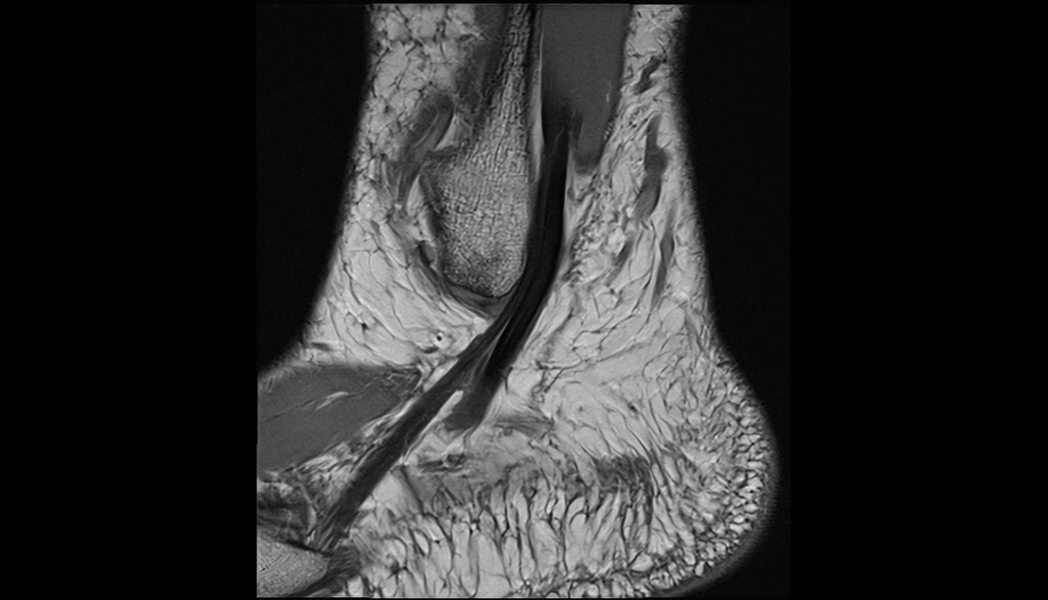 Fibularis brevis muscle   MRI sag  cross sectional anatomy 3T MRI AI enhanced radiology image-img-00000-00000_00003