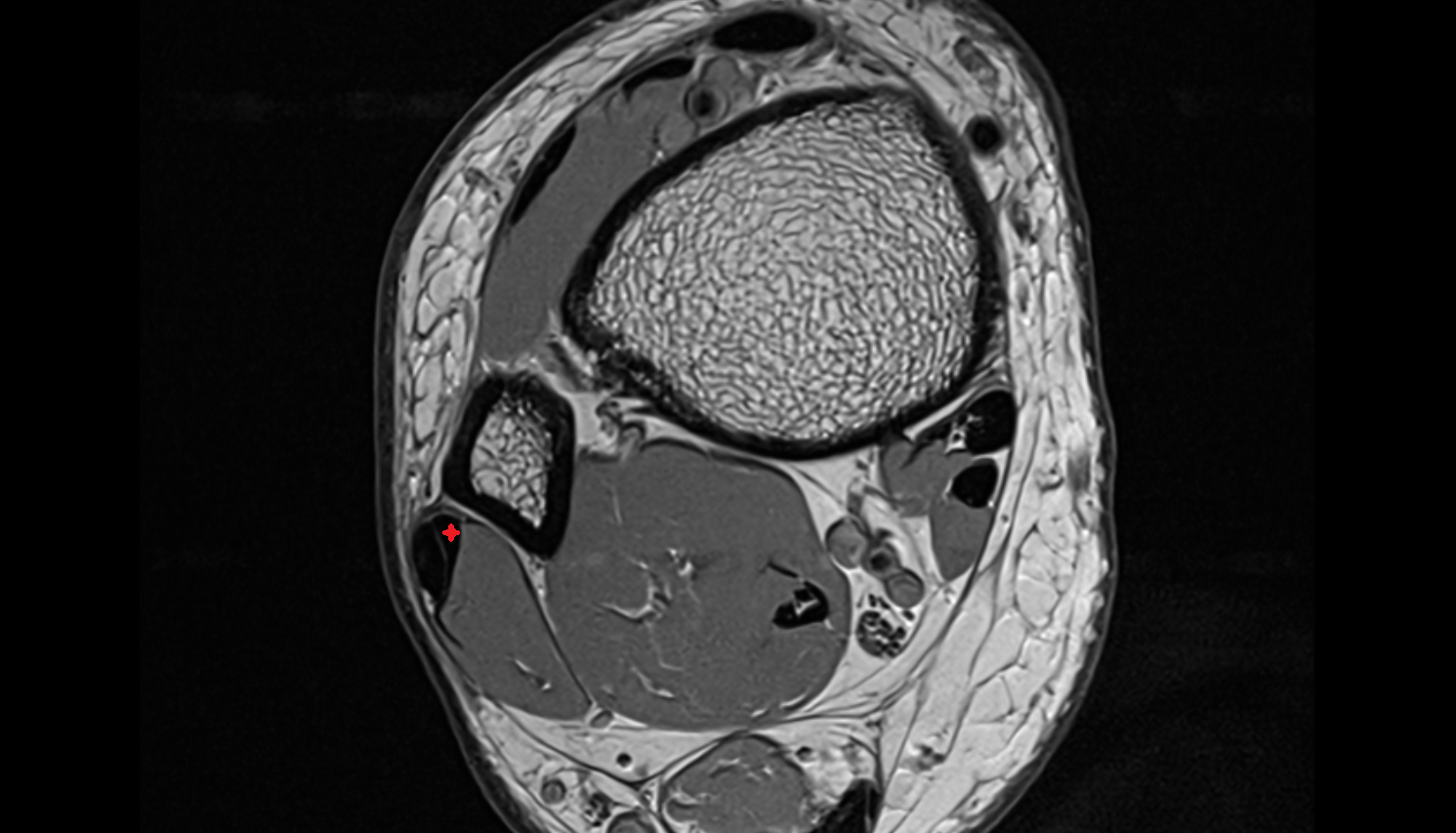 Fibularis brevis tendon   axial cross sectional anatomy 3T MRI AI enhanced radiology image-img-00000-00000