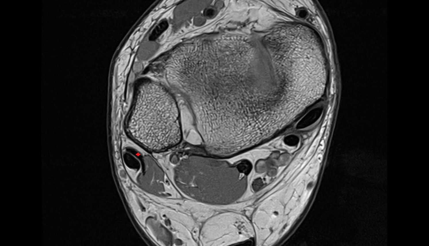 Fibularis brevis tendon   axial cross sectional anatomy 3T MRI AI enhanced radiology image-img-00000-00000_00001