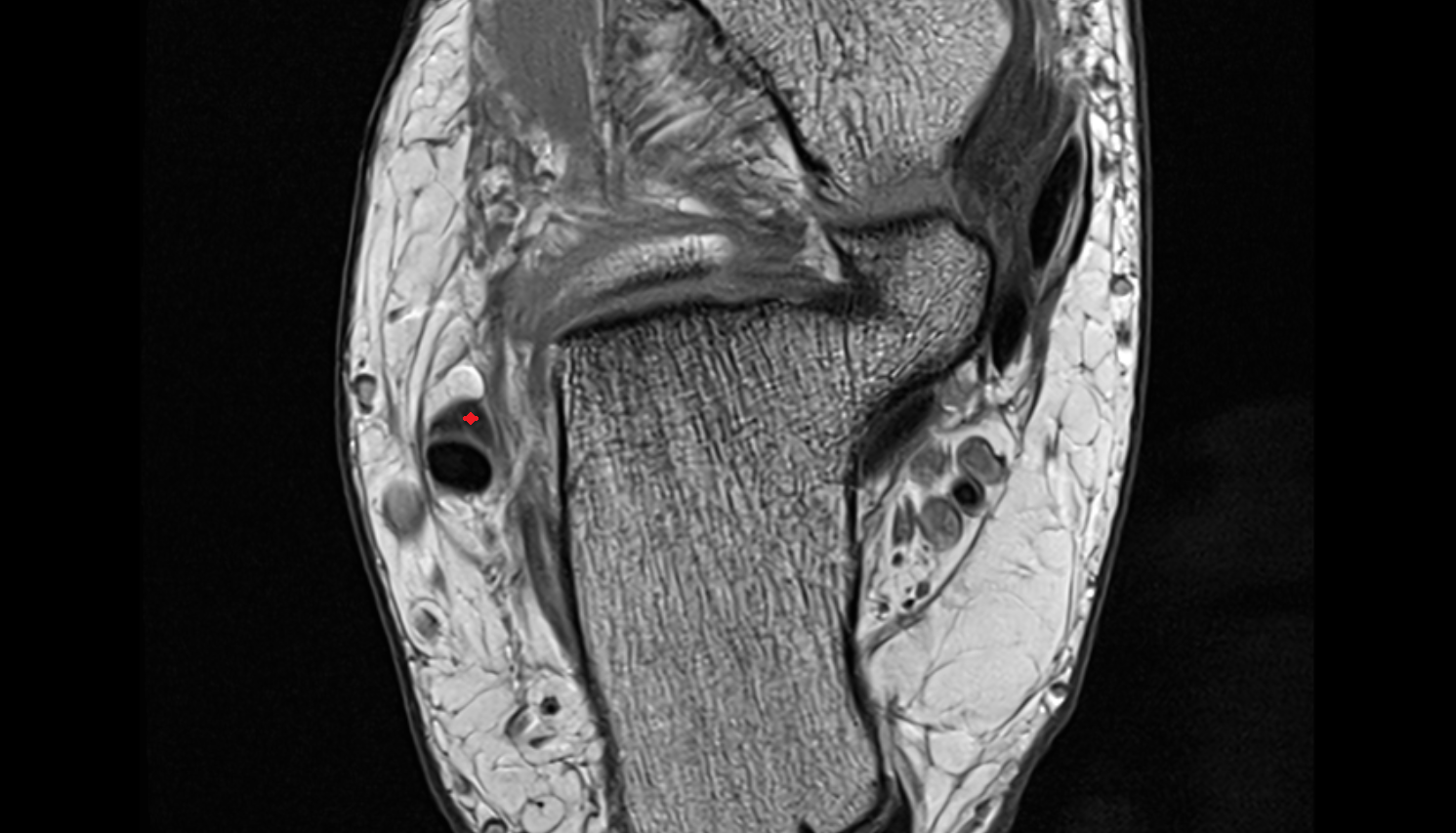 Fibularis brevis tendon   axial cross sectional anatomy 3T MRI AI enhanced radiology image-img-00000-00000_00002