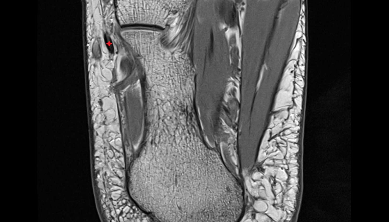 Fibularis brevis tendon   axial cross sectional anatomy 3T MRI AI enhanced radiology image-img-00000-00000_00003
