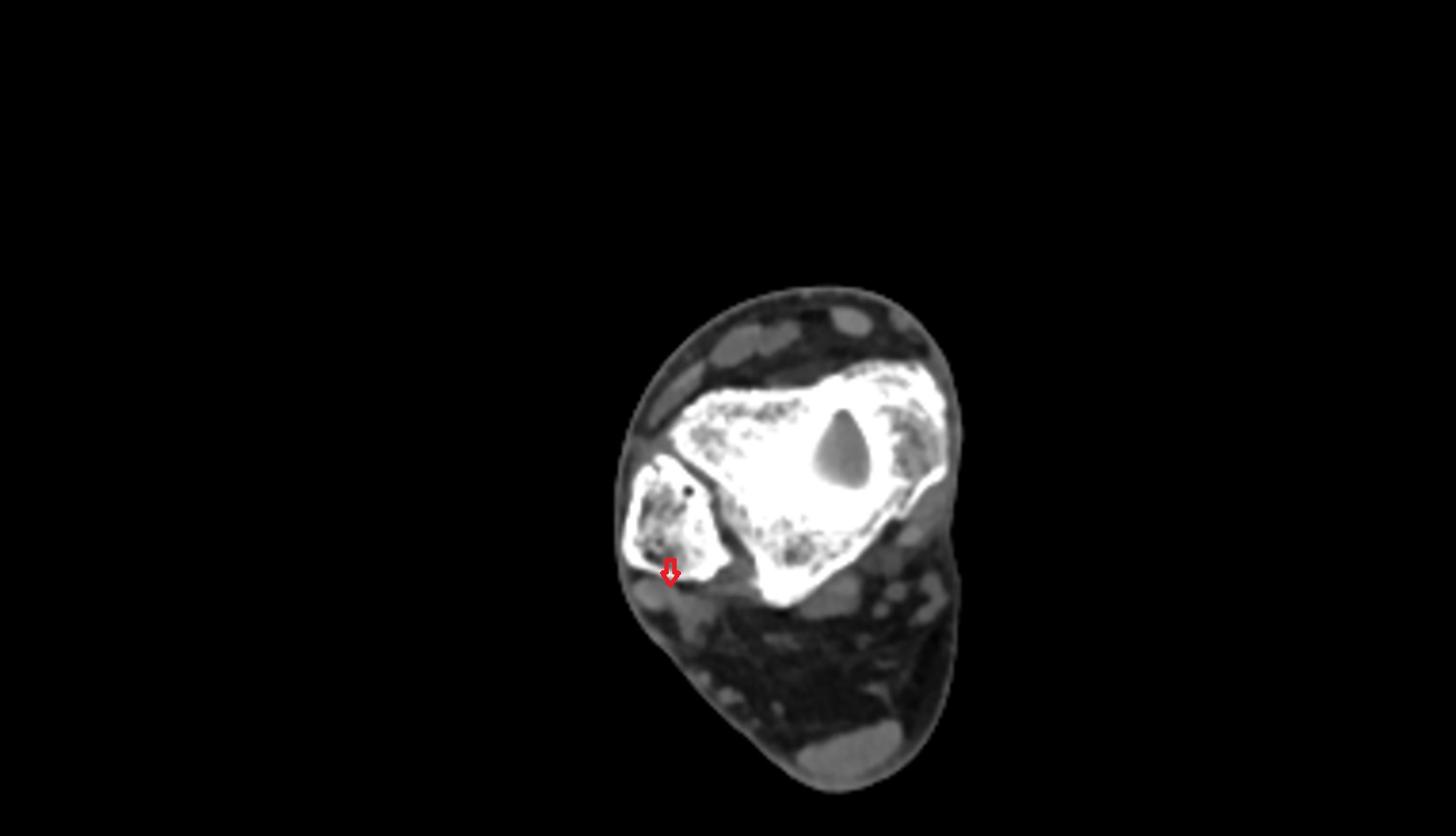 Fibularis brevis tendon ct axial image  1