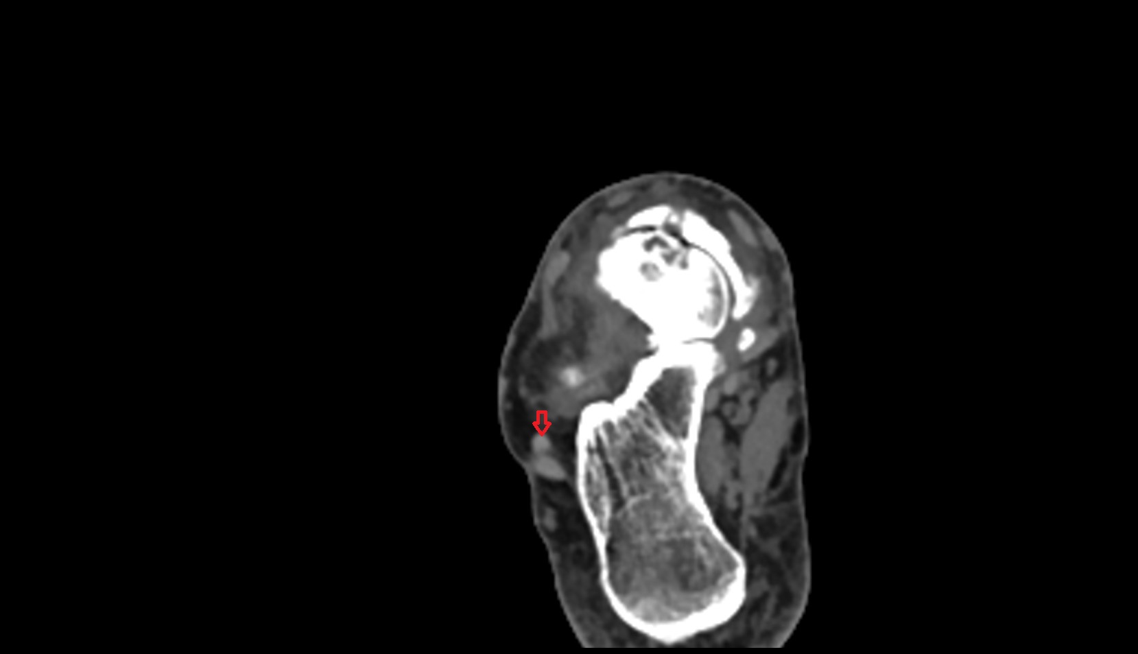 Fibularis brevis tendon ct axial image  2