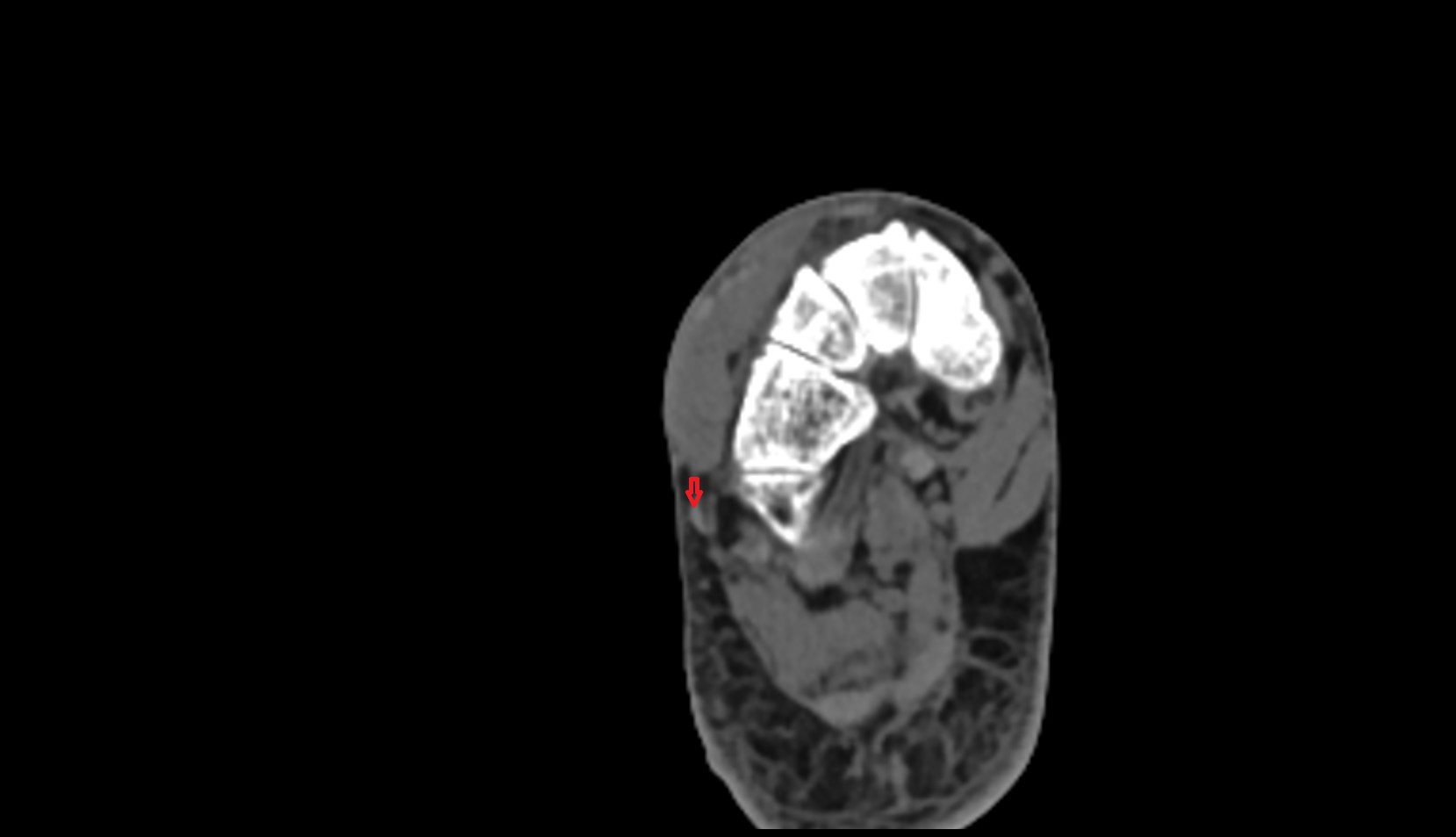Fibularis brevis tendon ct axial image  3