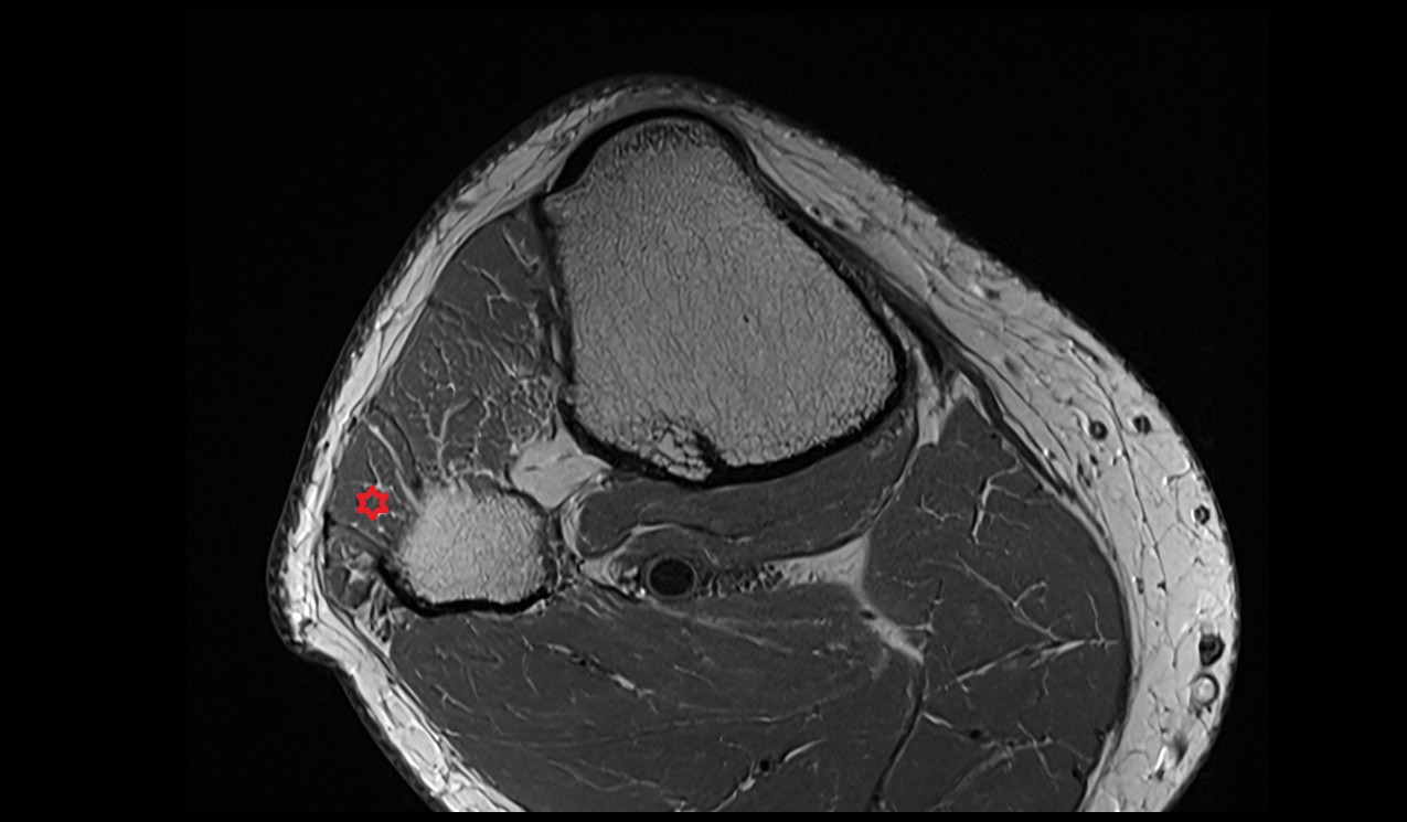 Fibularis longus muscle anatomy