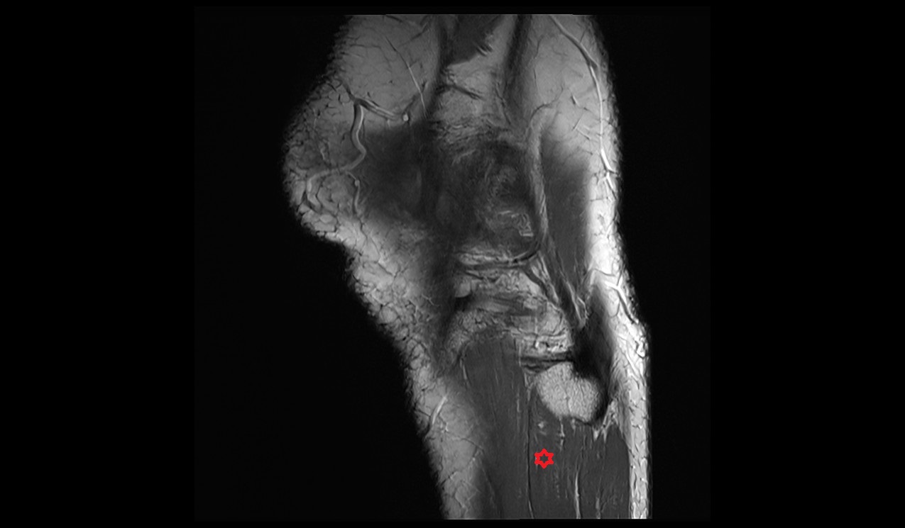 Fibularis longus muscle anatomy 3t MRI image