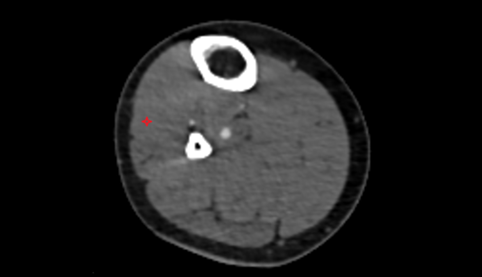 Fibularis longus (peroneus longus) muscle CT axial image 1