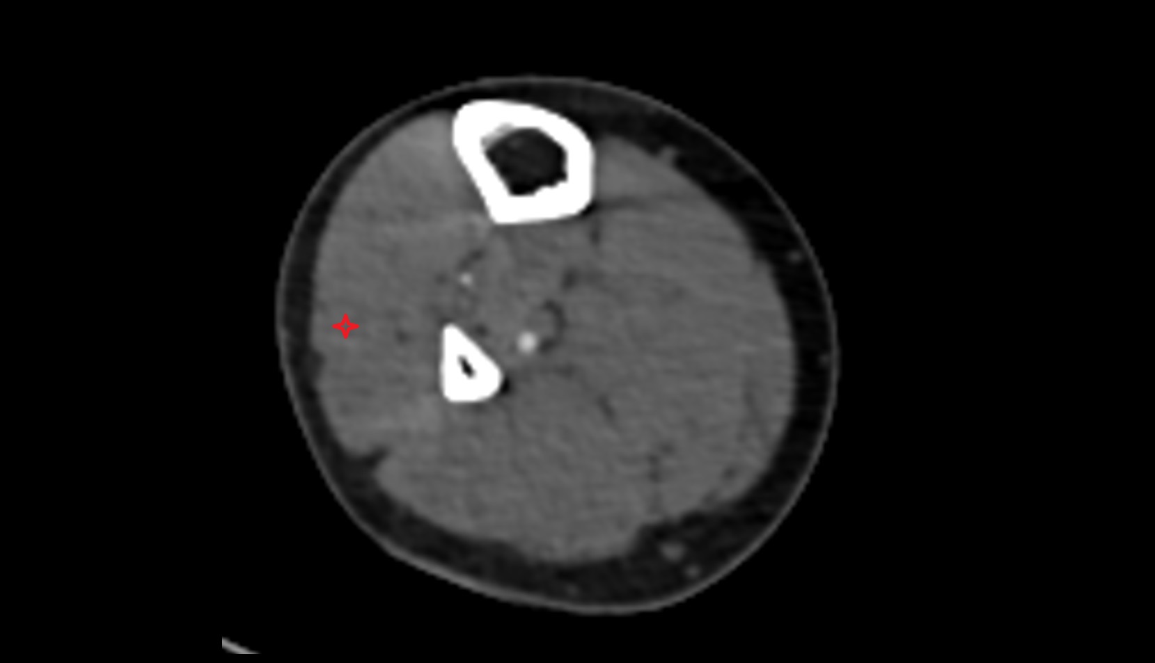 Fibularis longus (peroneus longus) muscle CT axial image 2