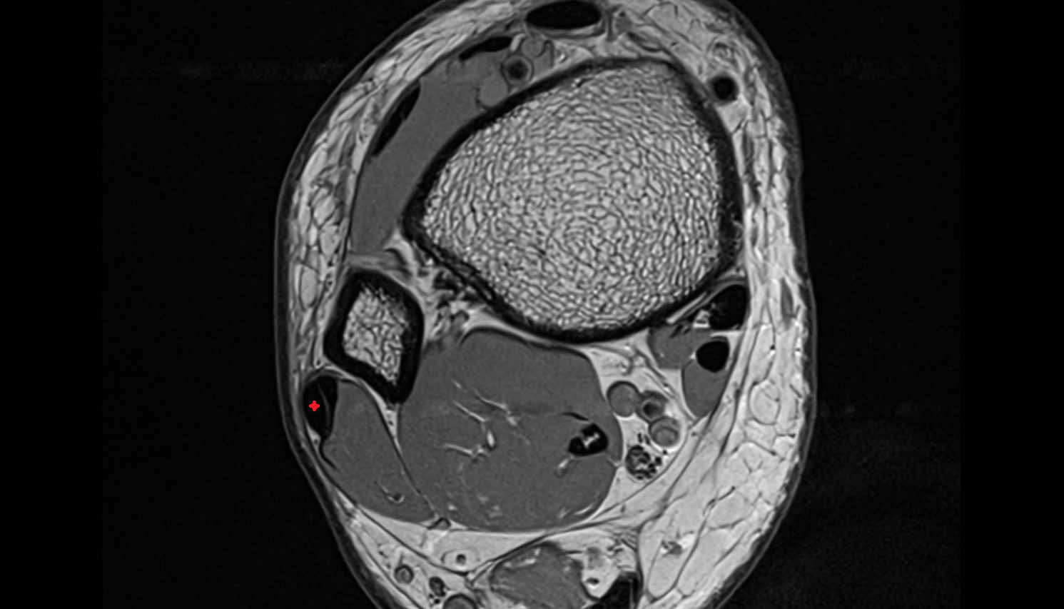 Fibularis longus tendon  axial cross sectional anatomy 3T MRI AI enhanced radiology image-img-00000-00000