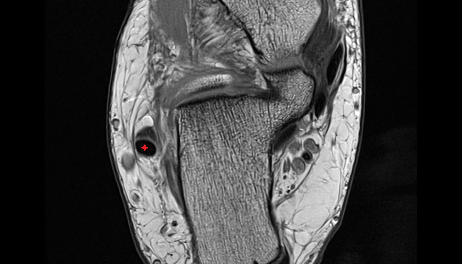 Fibularis longus tendon  axial cross sectional anatomy 3T MRI AI enhanced radiology image-img-00000-00000_00002