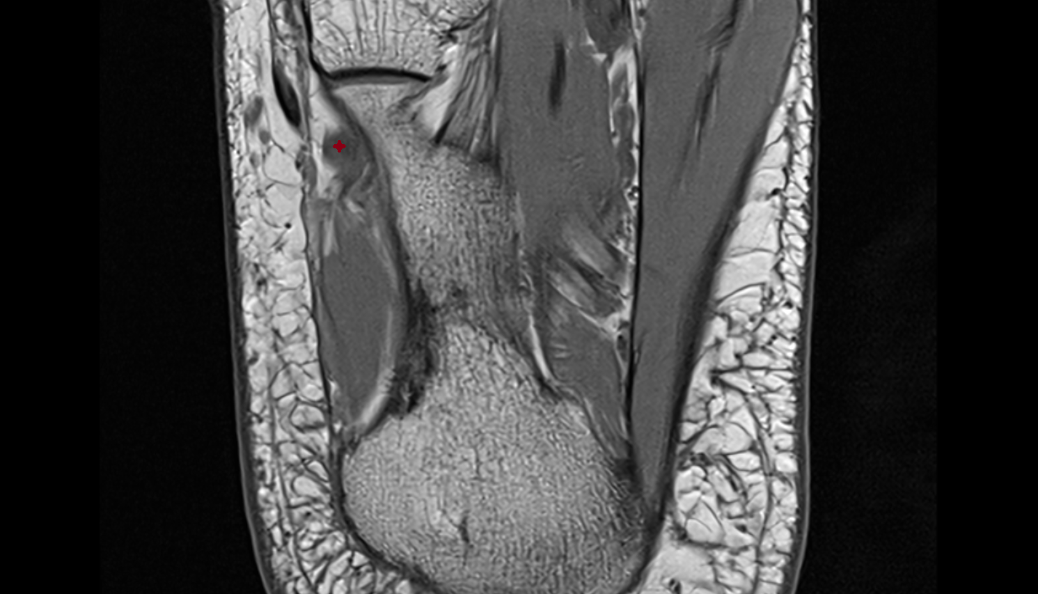 Fibularis longus tendon  axial cross sectional anatomy 3T MRI AI enhanced radiology image-img-00000-00000_00003
