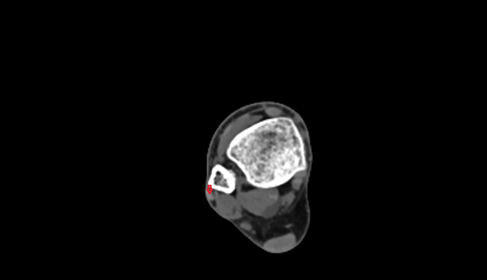 Fibularis longus tendon ct axial image 1