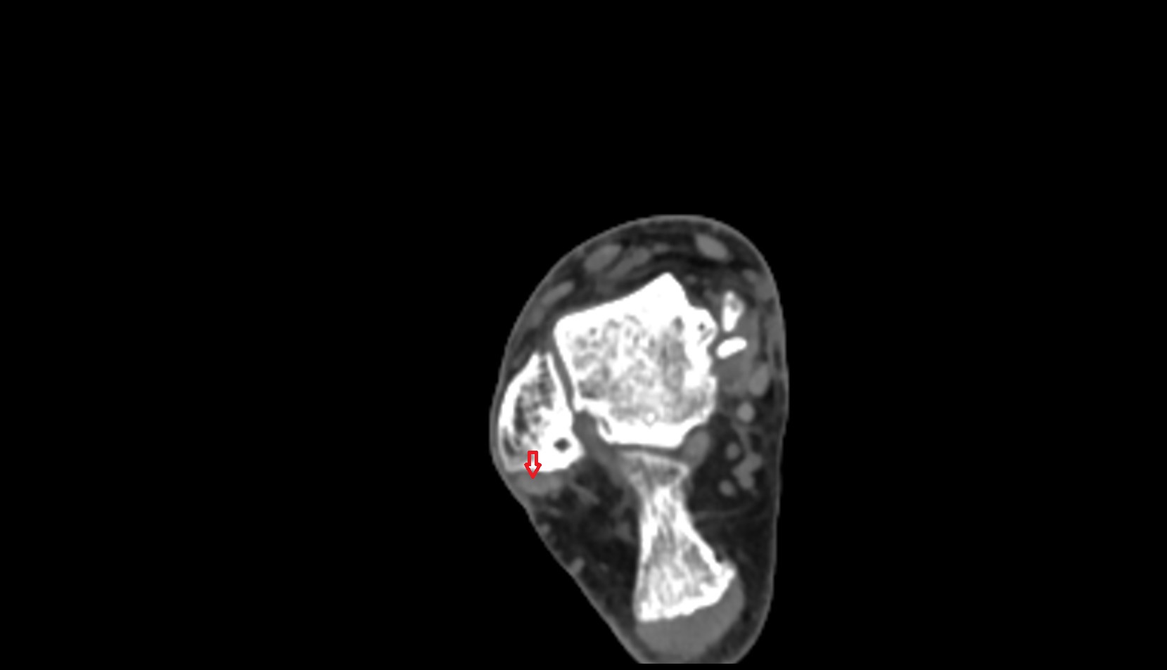 Fibularis longus tendon ct axial image 2
