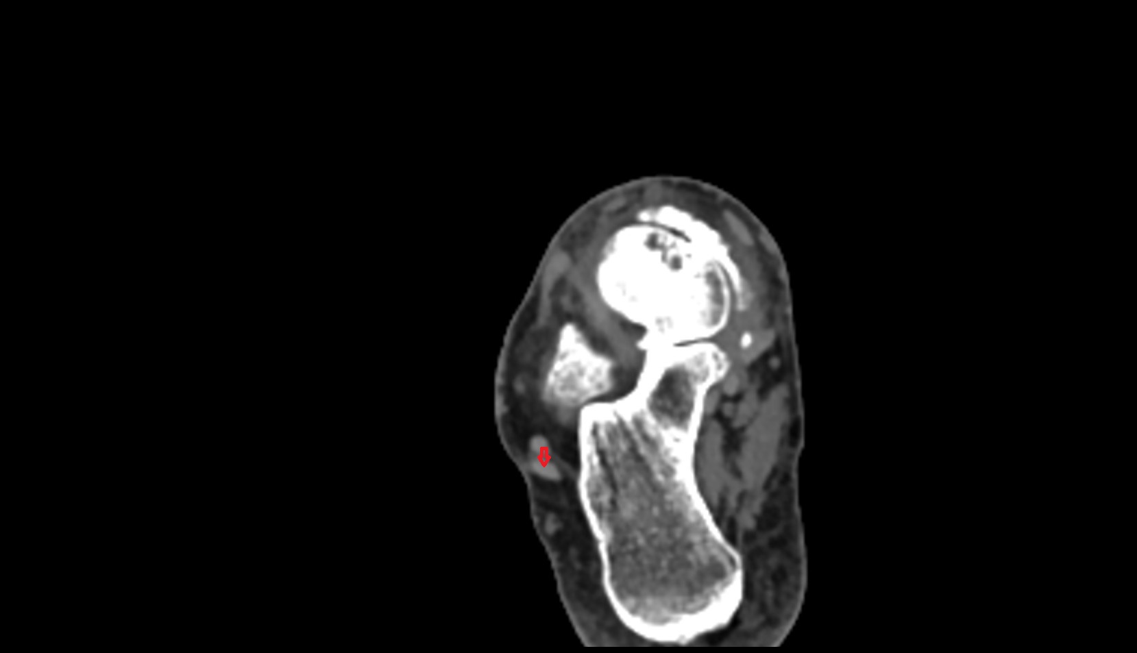Fibularis longus tendon ct axial image 3