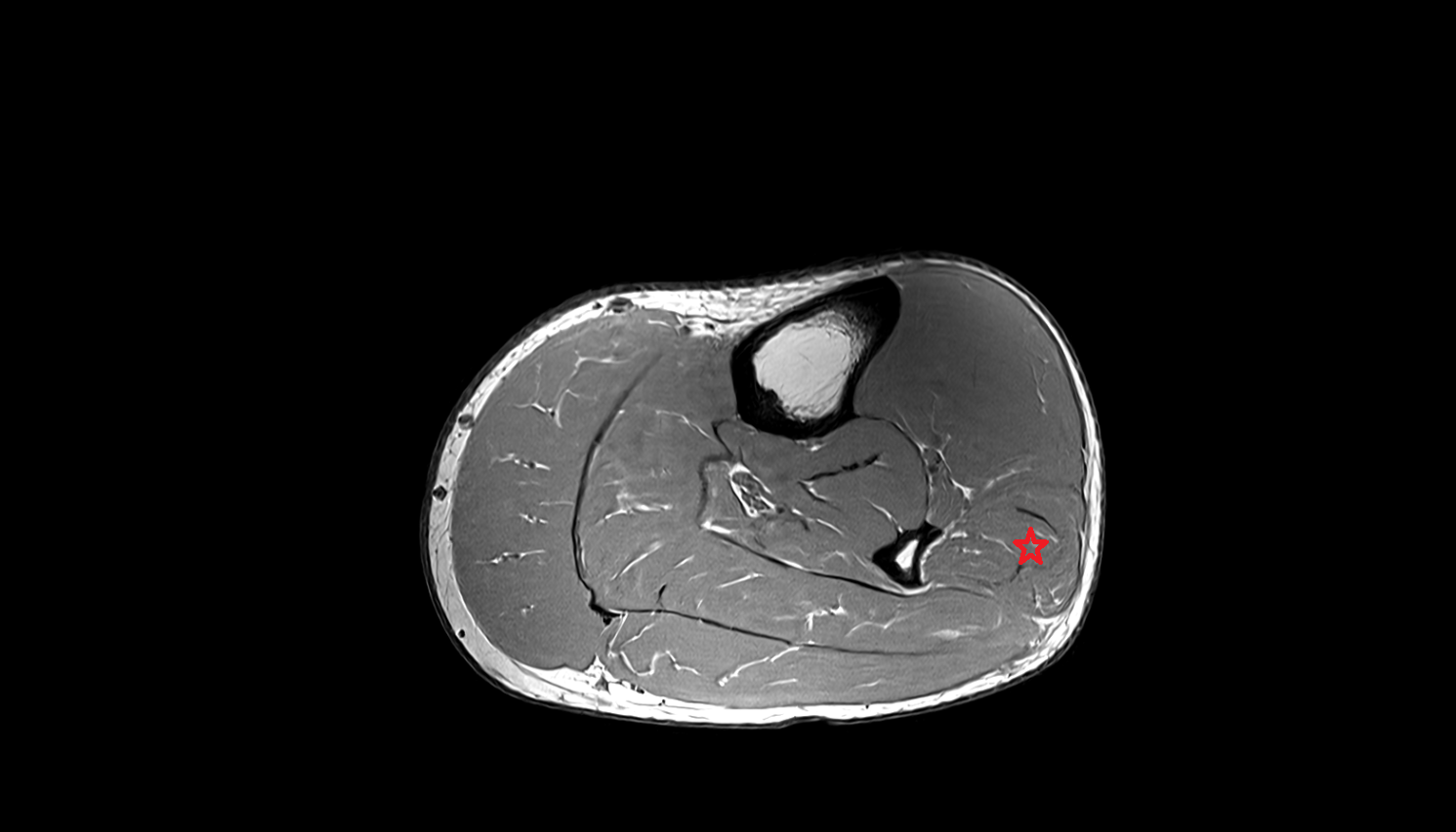 Fibularis (peroneus) longus muscle sagittal cross sectional anatomy 3T MRI AI enhanced radiology image 1