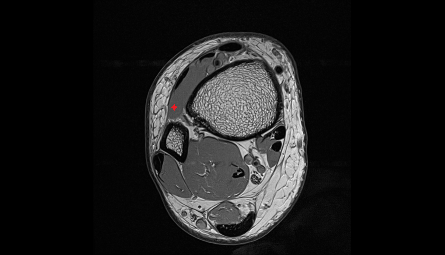 Fibularis (peroneus) tertius muscle   MRI axial  cross sectional anatomy 3T MRI AI enhanced radiology image-img-00000-00000