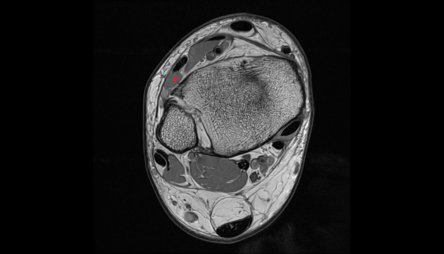Fibularis (peroneus) tertius muscle   MRI axial cross sectional anatomy 3T MRI AI enhanced radiology image-img-00000-00000_00001