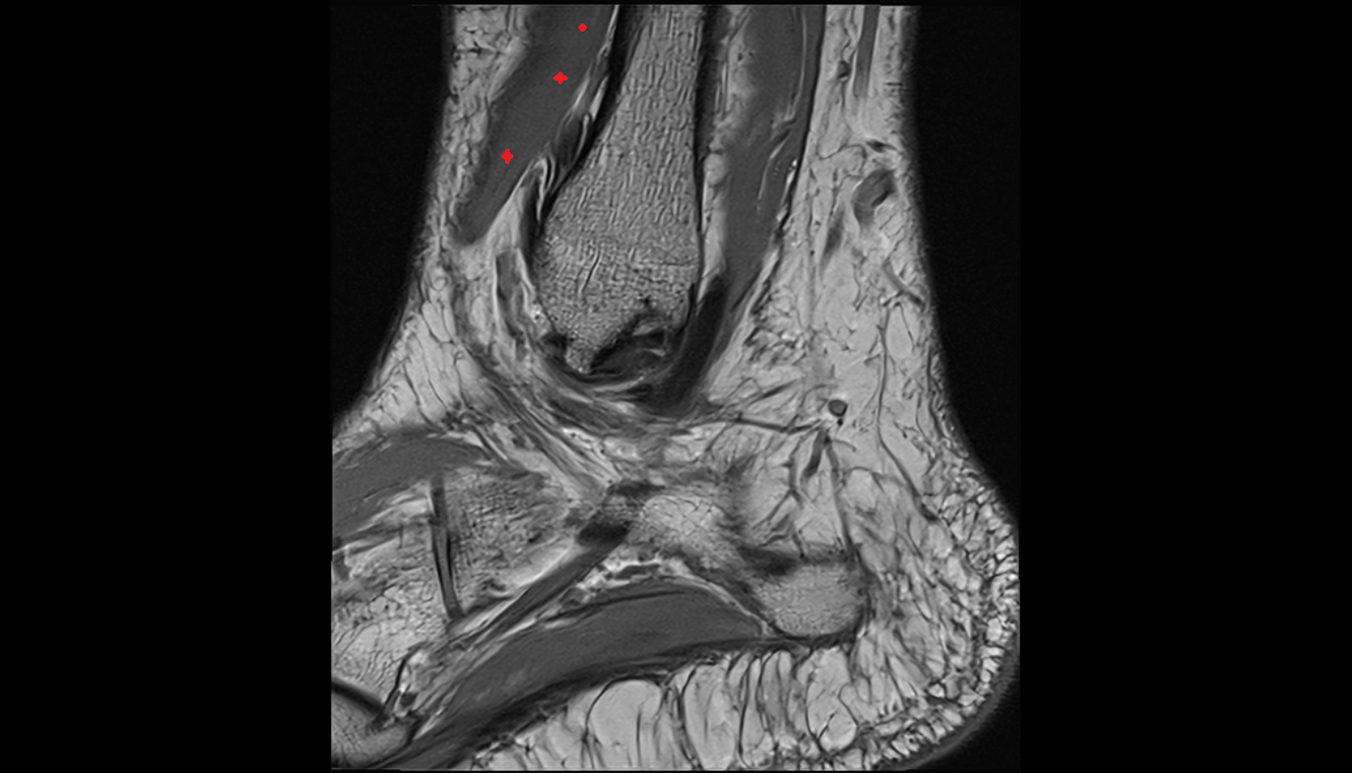 Fibularis (peroneus) tertius muscle   MRI sag  cross sectional anatomy 3T MRI AI enhanced radiology image-img-00000-00000_00002