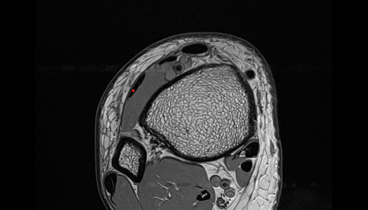 Fibularis tertius tendon   axial cross sectional anatomy 3T MRI AI enhanced radiology image-img-00000-00000