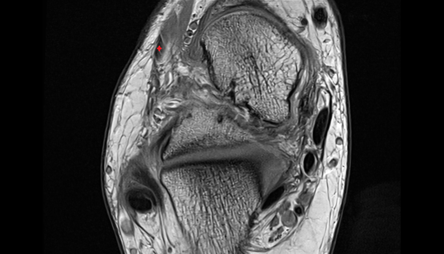 Fibularis tertius tendon   axial cross sectional anatomy 3T MRI AI enhanced radiology image-img-00000-00000_00002