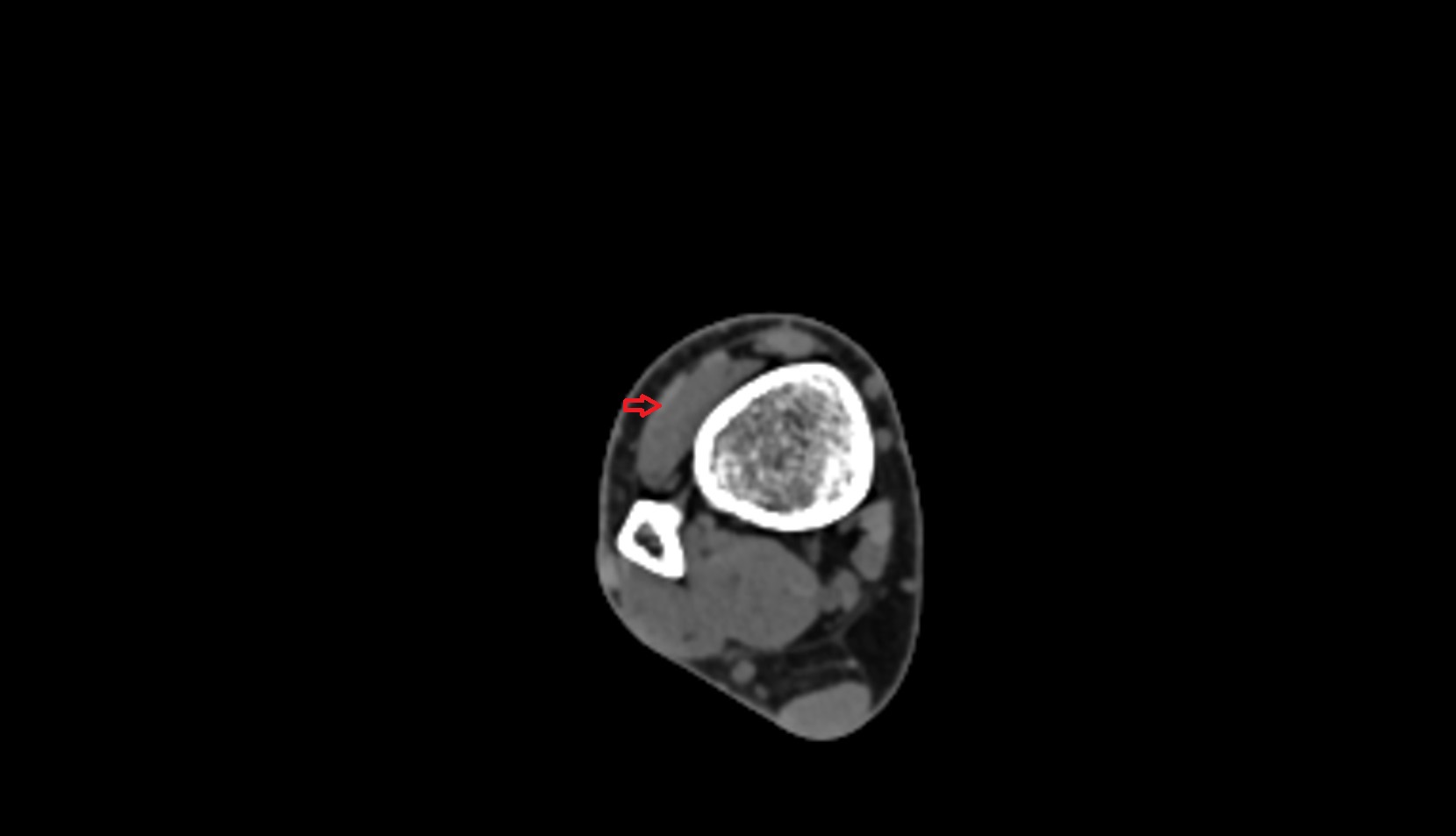 Fibularis tertius tendon ct axial image 0