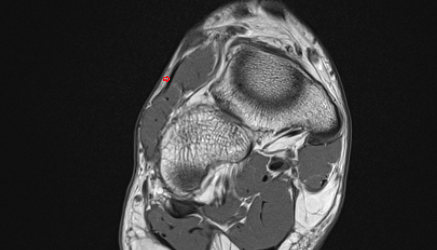 Fibularis tertius tendon  of the Foot  axial cross sectional anatomy 3T MRI AI enhanced radiology image-img-00000-00000