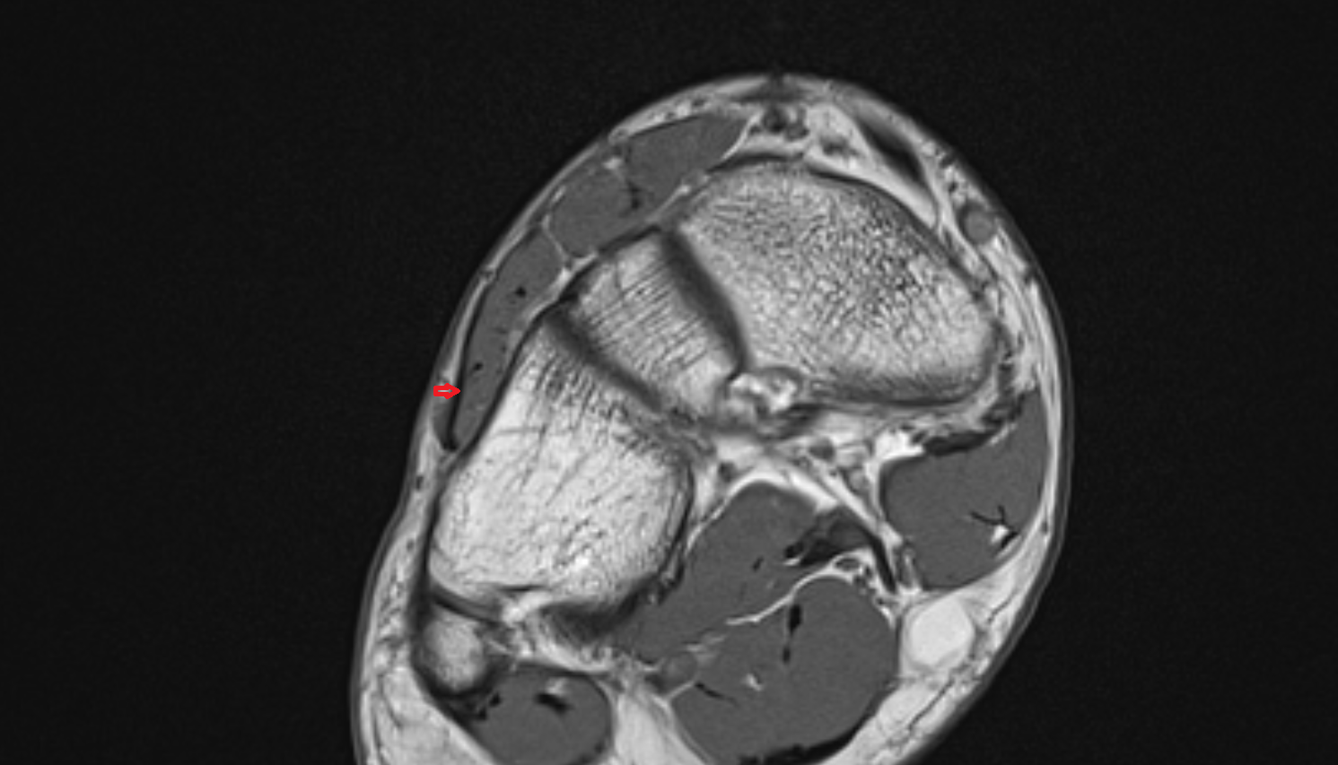 Fibularis tertius tendon  of the Foot  axial cross sectional anatomy 3T MRI AI enhanced radiology image-img-00000-00000_00001