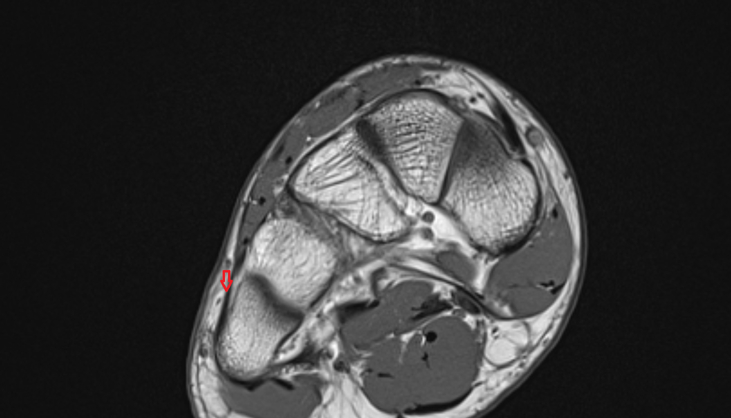 Fibularis tertius tendon  of the Foot  axial cross sectional anatomy 3T MRI AI enhanced radiology image-img-00000-00000_00002